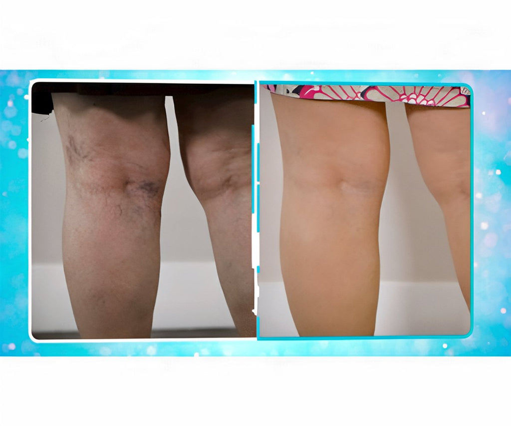 Veins Gone 2x1 a 202 LEU